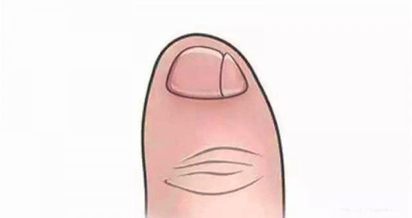 小脚趾甲分瓣是哪族人