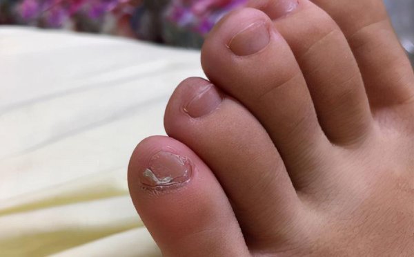 小脚趾甲分瓣是哪族人