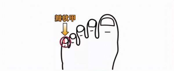 小脚趾甲两瓣的来历