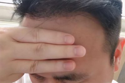 标准发际线是几指宽 正常发际线在哪个位置