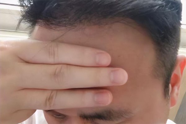 标准发际线是几指宽