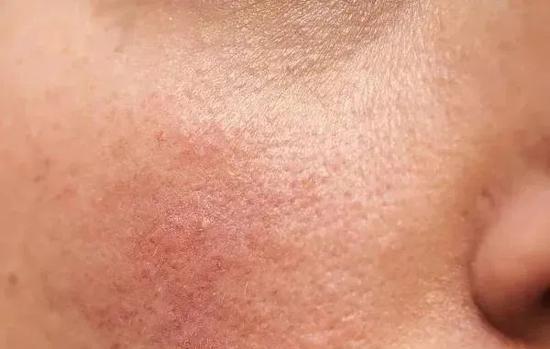 脸上搓出白泥是角质吗