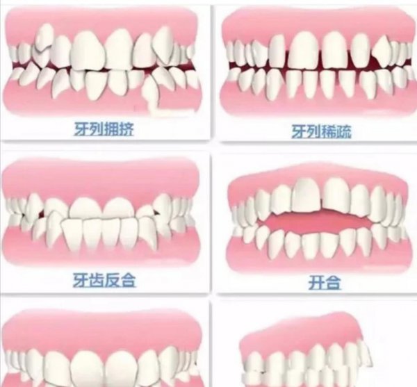 牙齿矫正的危害是什么