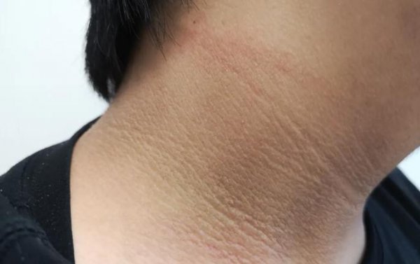 脖子黑色素怎么去除