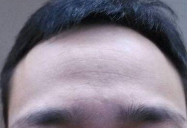 男人印堂凹陷是什么征兆