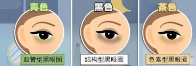 怎么判断黑眼圈是什么类型的 黑眼圈应该怎么改善效果最好