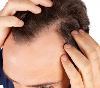 治疗斑秃的最好办法 源头解决脱发问题