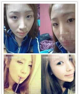 分享吸脂去除眼袋的效果 揭秘吸脂祛除眼袋的效果