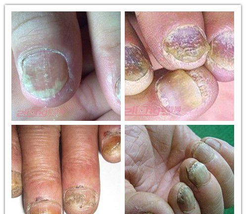 灰指甲初期症状图片及表现