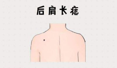 男人肩膀上有痣代表什么含义 男人肩膀痣的意义是什么？
