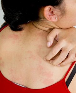 汗斑怎么治疗最快 汗斑会传染吗 汗斑治疗方法