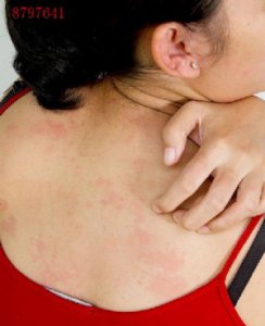 皮肤为什么会过敏？如何应对皮肤过敏？