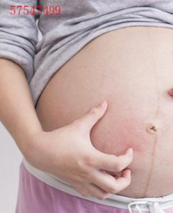 肥胖纹和妊娠纹分别是怎样的？有什么预防和恢复措施？