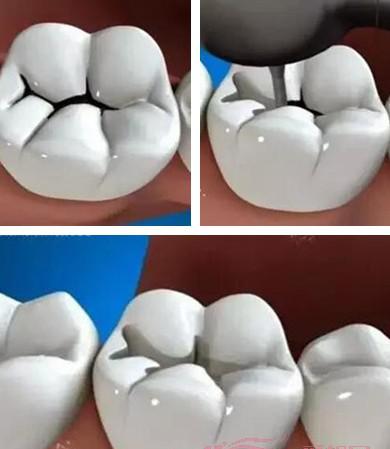 超详细的补牙洞过程图解分享