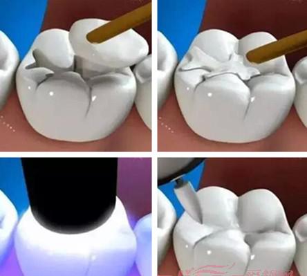 超详细的补牙洞过程图解分享