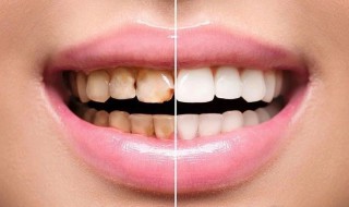 白牙的最快方法有效 牙齿变白最快的有效方法