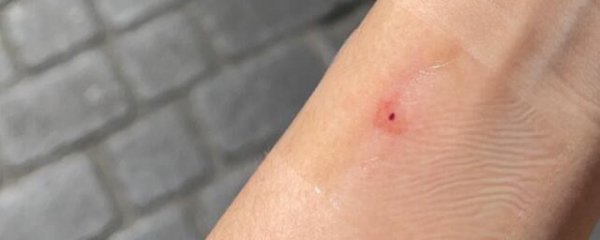 朱砂痣什么样