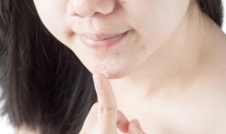 祛痘小妙招简单实用的方法 简单实用的祛痘小窍门