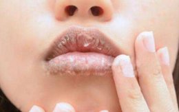 嘴唇干裂脱皮是什么原因？四个原因显而易见别不当回事