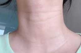 颈纹可以通过运动消除吗 通过护肤运动能消除颈纹吗