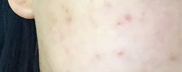 用食用盐水可以祛痘吗