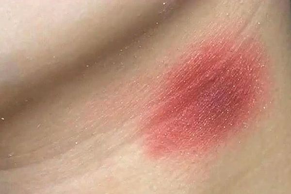 脖子被种草莓如何快速消除