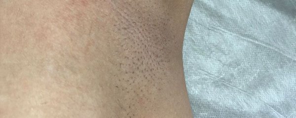 腋毛剪短了太扎怎么办