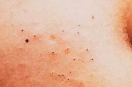 去黑头千万不要用鼻贴 脸上有黑头可以用鼻贴吗