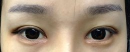 眼睛从双眼皮到单眼皮这是为什么 眼皮为什么从双眼皮变成单眼皮了
