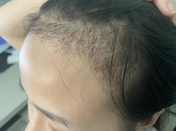 经常梳头发有助于生发吗