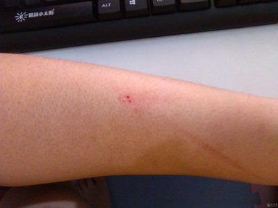 老鼠咬人有毒吗 宠物鼠咬人有毒吗