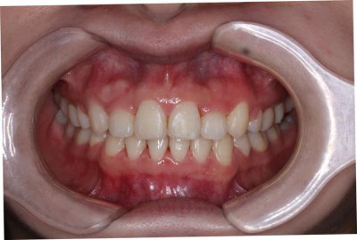 牙线用多了牙缝会变大吗 牙线真的会让牙缝变大吗?来看看真相吧