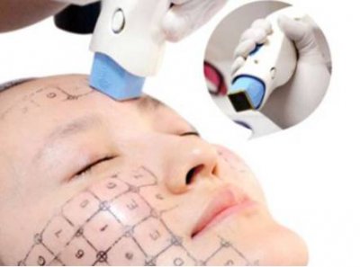 热玛吉600发和900发的效果区别有哪些 做热玛吉怎么选择发数