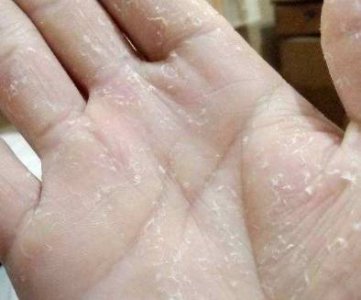 手干裂起皮怎么办 手部护理的正确方法