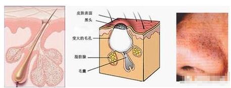 黑头是怎么形成的原因？怎么避免长黑头