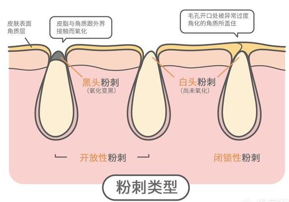 黑头是怎么形成的原因？怎么避免长黑头