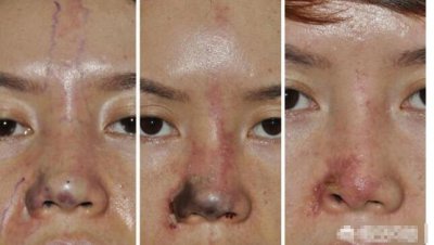 玻尿酸注射隆鼻失败怎么办 玻尿酸隆鼻多次注射会怎么样