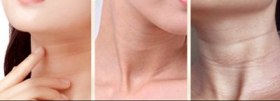 颈纹很深很难看怎么办 颈纹深代表身体不好