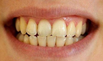 简单美白牙齿小妙招 美白牙齿的方法和小妙招