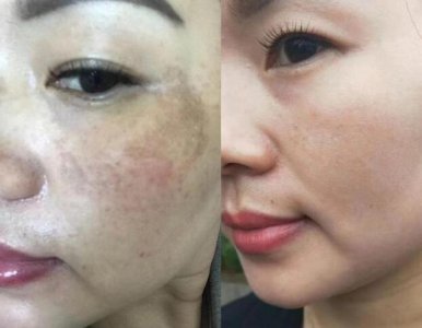 正确的美白方法有哪些？ 美白用什么方法最好的方法