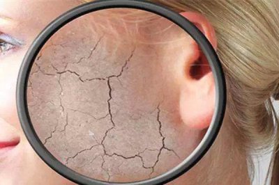 脸上有红血丝怎么办？脸上红血丝是什么原因造成的？