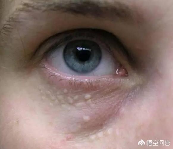 脸上有一粒一粒的东西是什么？怎么办