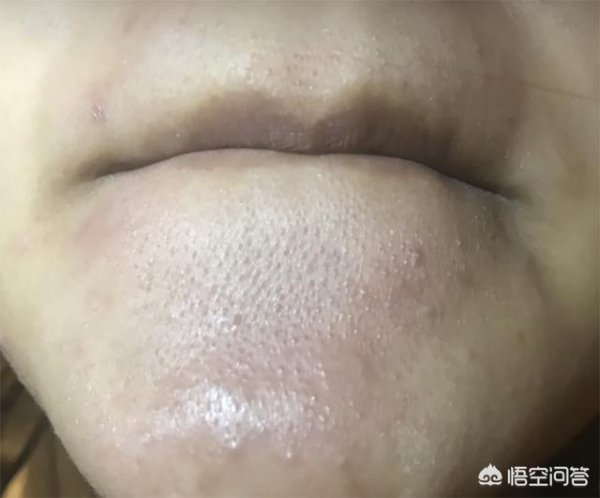 脸上有一粒一粒的东西是什么？怎么办
