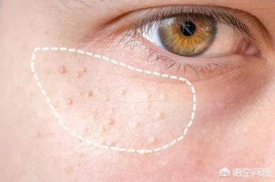脸上有一粒一粒的东西是什么？怎么办