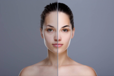 毛孔大怎么办 毛孔大的解决办法