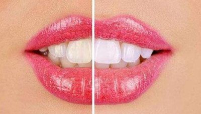 牙齿轻微发黄怎样才能变白 牙齿发黄怎么办 变白小窍门