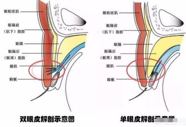 什么样的单眼皮做双眼皮手术？