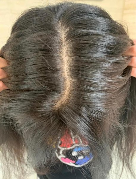 为什么头发越来越少