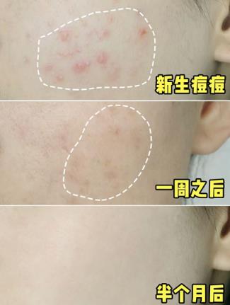 欧慕慕真的能祛痘吗