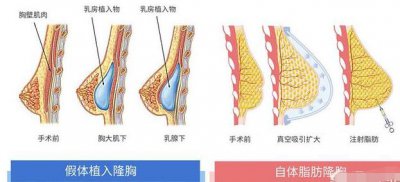 隆胸都是什么填充物？ 隆胸主要是用什么填充乳房